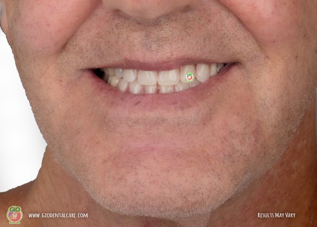gio-dental-implants-1